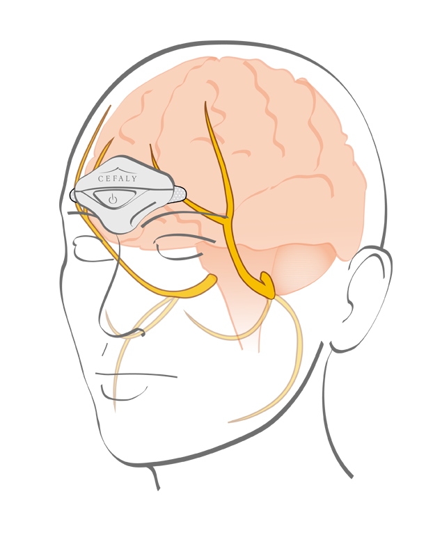 Diapo 3 : Dessin représentant l'impact de Cefaly sur le cerveau