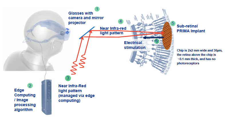 Diapo 3 : Un schéma en anglais d'explication de comment fonctionne Prima : les lunettes et caméra interprète les images grace au petit ordinateur embarqué, les faisceaux infrarouges ainsi créé stimule électriquement la rétine artificielle qui envoie donc des informations au cerveau